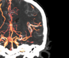 Hometown Highlights CGRP Related Treatments for Headache