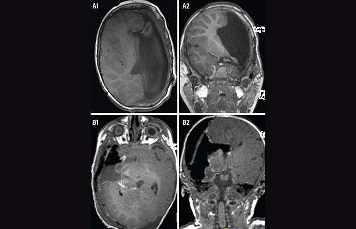 Epilepsy Essentials Hemispherectomy for Early Onset Pediatric Epilepsy A Big Surgery for Small People
