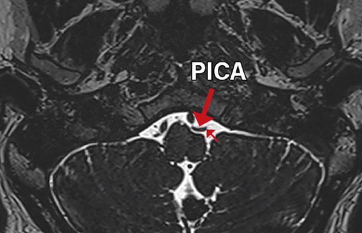 Persistent Idiopathic Isolated Hypoglossal Nerve Palsy