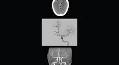 Headache Horizons Reversible Cerebral Vasoconstriction Syndrome Presentation Diagnosis and Treatment of a Complex Neurova