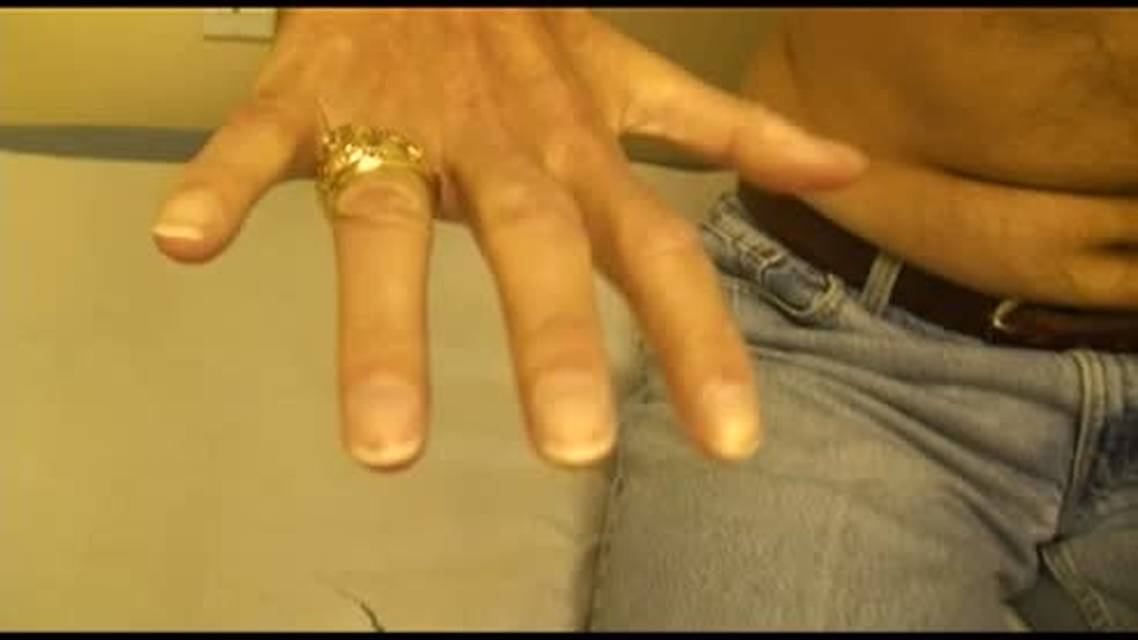 Weakness and Atrophy of Right Hand Muscles in A 47yearold Man thumbnail