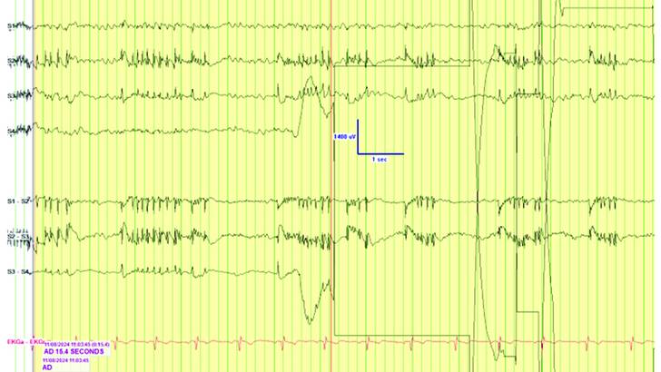 End Program Eeg Practical Uses of EEG in the Operating Room
