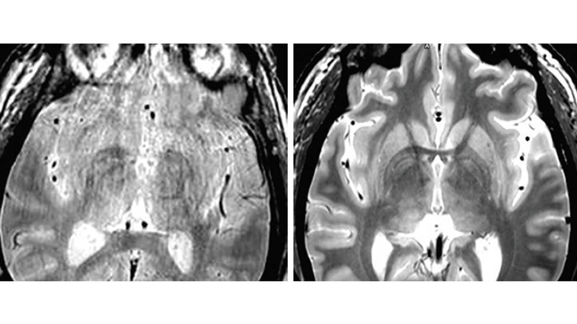 Movement Disorders Moment Asleep Deep BrainStimulation