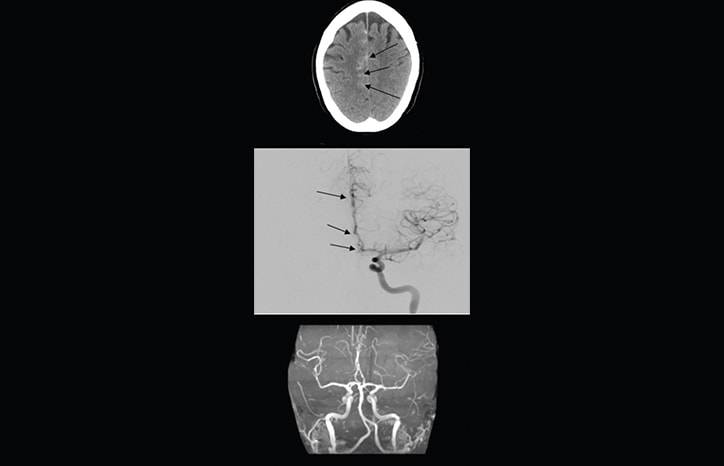 Headache Horizons Reversible Cerebral Vasoconstriction Syndrome Presentation Diagnosis and Treatment of a Complex Neurova