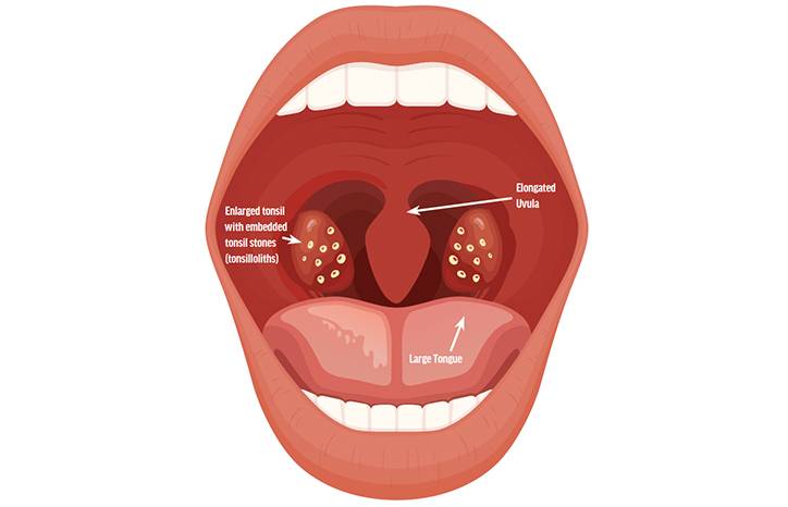 Tonsillectomy for the Treatment of Suspected Sleep Apnea with Subsequent Improvement of Chronic Migraine