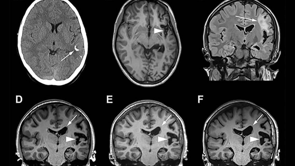 Parry Romberg Syndrome With Drug Resistant Epilepsy