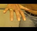 Weakness and Atrophy of Right Hand Muscles in A 47yearold Man thumbnail
