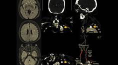 An Unusual Case of a Vertebrobasilar Transient Ischemic Attack Involving the Subclavian Steal Syndrome