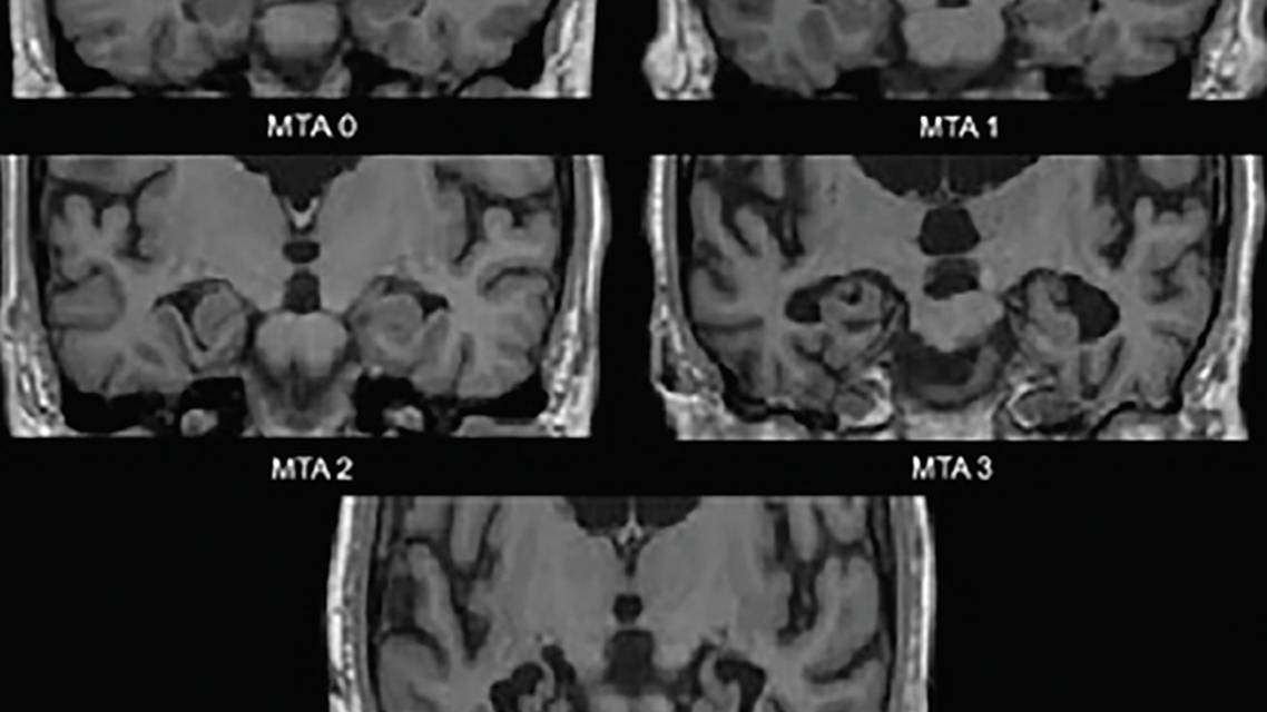 Brain Imaging in Differential Diagnosis of Dementia