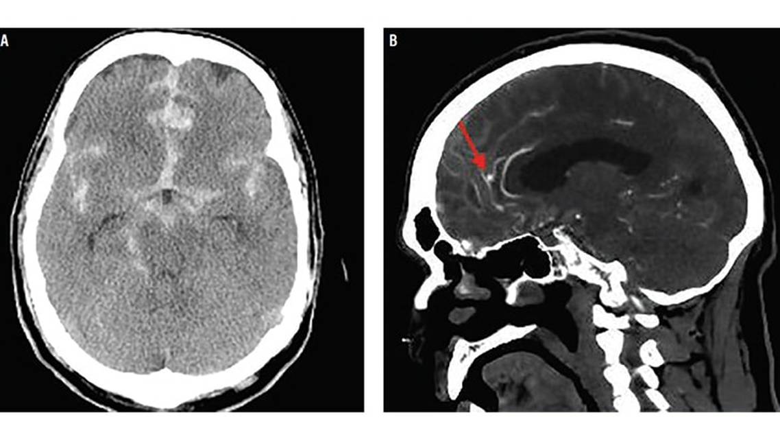 Case Report Cerebral Aneurysm Rerupture