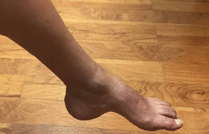 Challenge Case Report Weakness and Wasting of the Left Foot With Pes Cavus