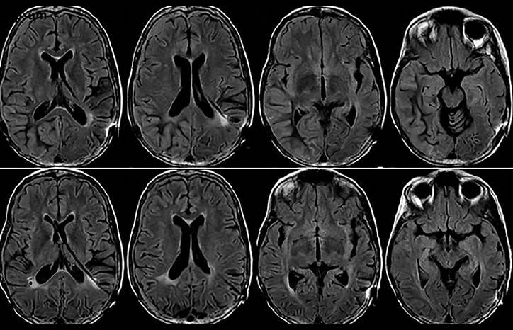 Seizures Visual Auras and Diffuse Cortical Enhancement