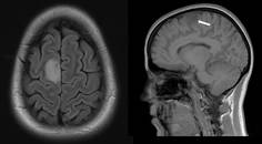 Supplementary Motor Area Glioma Presenting with Musicogenic Epilepsy Singing Seizures