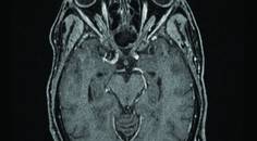 Perez Fig 2C Optic Nerve Image