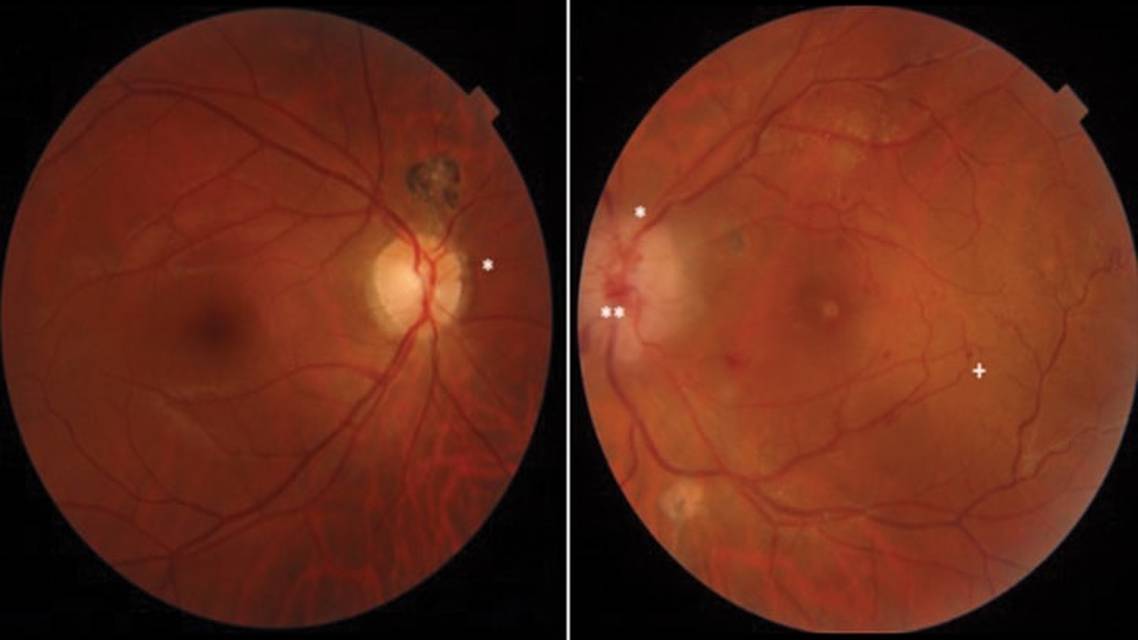 Cytomegalovirus and Herpes Simplex Virus Coinfection Neuroretinitis in an Immunocompetent Individual