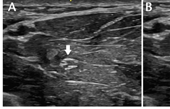 Neuromuscular Notes Neuromuscular Ultrasound in Polyneuropathy