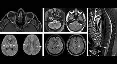 MS Minute Myelin Oligodendrocyte Glycoprotein AntibodyAssociated Disease