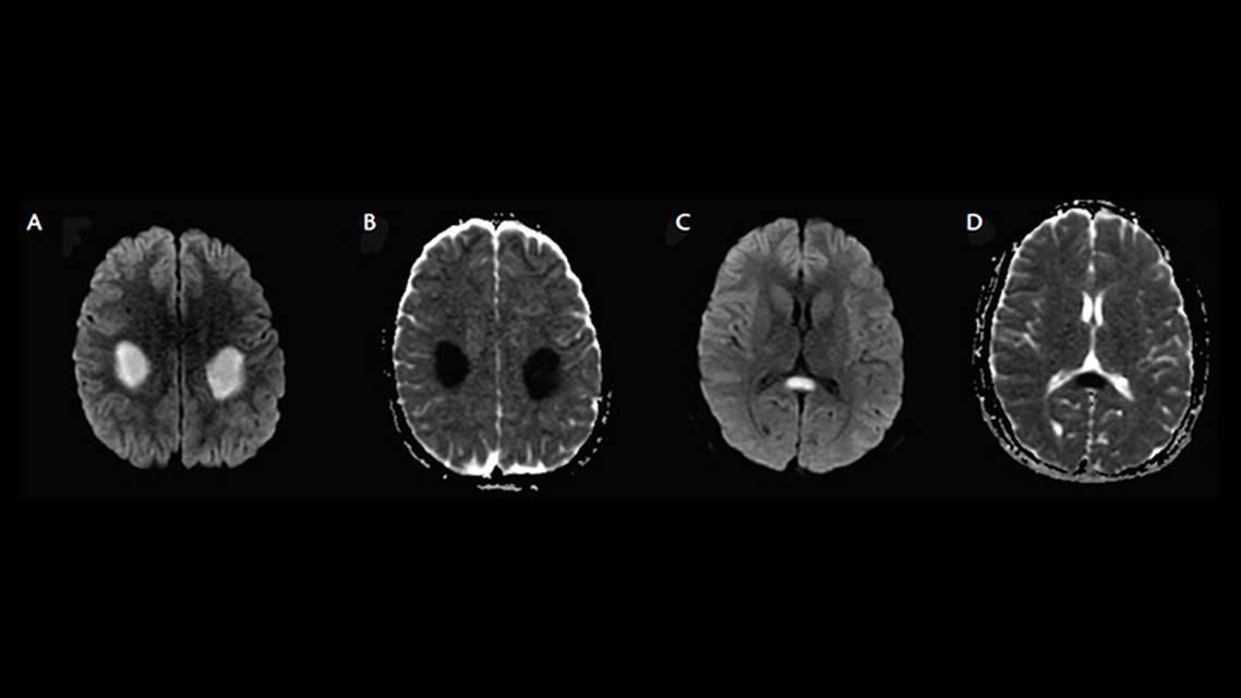 Recurrent Stroke Like Events Before Diagnosis of X Linked CharcotMarieTooth Disease