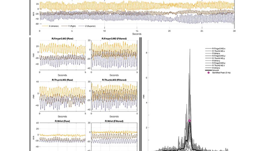 Movement Disorders Moment Use of 3D Motion Capture for Kinematic Analysis in Movement Disorders