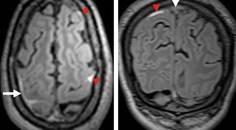 Cerebral Venous Thrombosis Presenting as Recurrent Transient Ischemic AttackLike Episodes