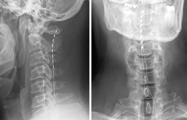 Implantable Neuromodulation for Chronic Pain and Headache