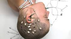 Diagnostic and Treatment Delay in Temporal Lobe Epilepsy