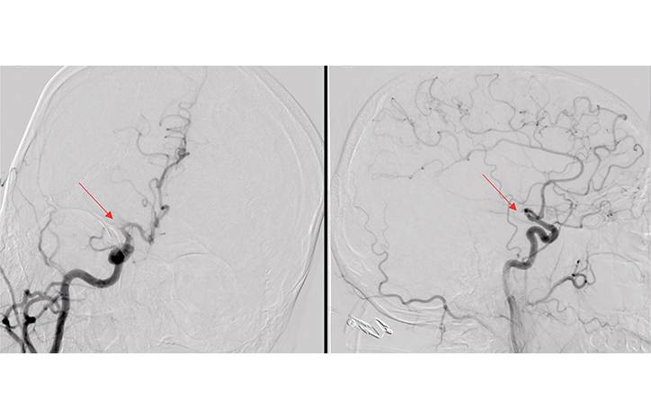 Stroke Snapshot Intracranial Vasculopathy in COVID 19