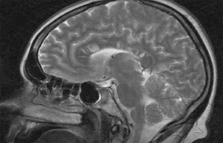 Susac Syndrome