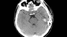 Challenge Case Report PostCOVID 19 Encephalitis