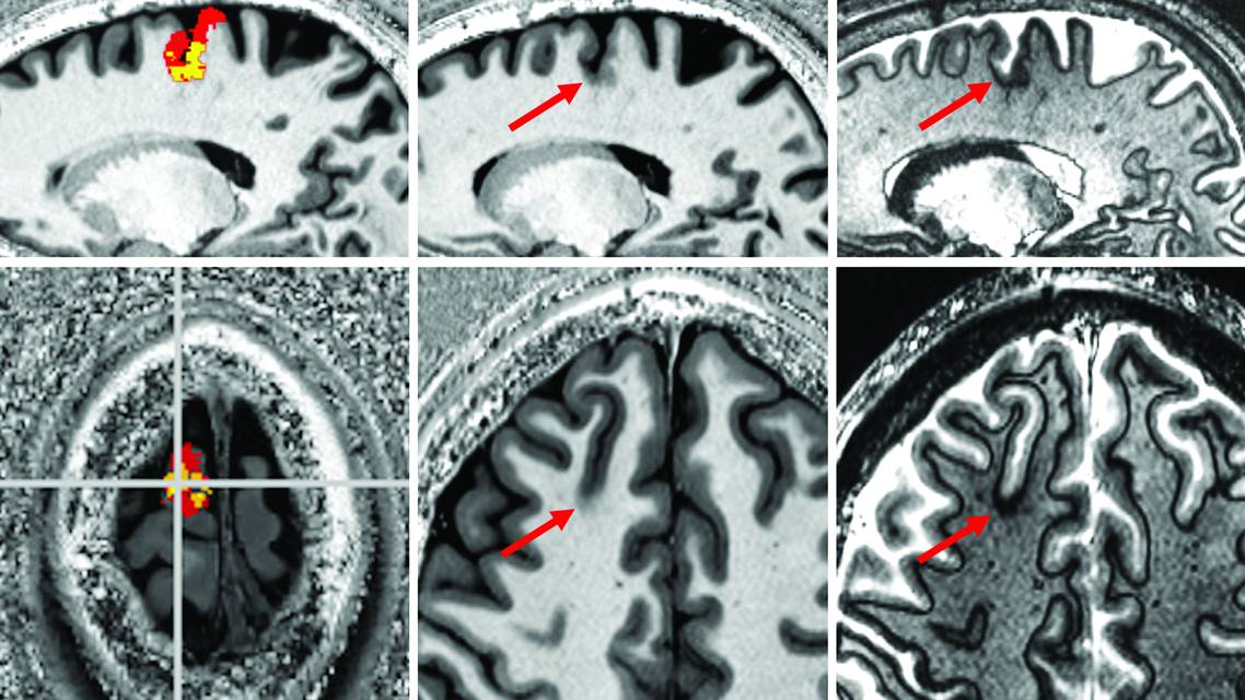 Figure 1 from the Epilepsy Essentials column article by Drs Ekert and Middlebrooks