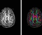 TBI Today Quantitative Diffusion Tensor Imaging for Assessment of Mild Traumatic Brain Injury