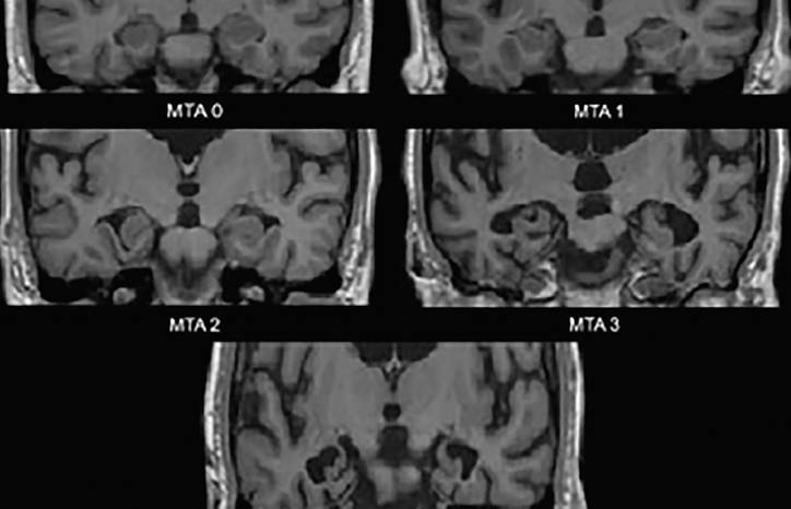 Brain Imaging in Differential Diagnosis of Dementia