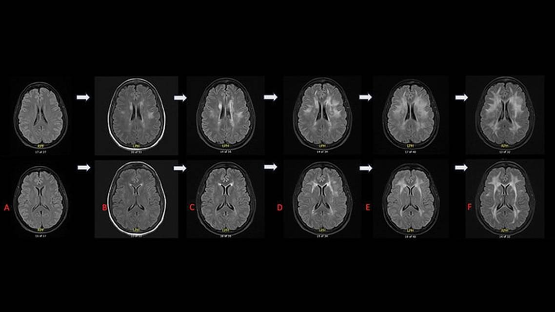 An Unusual Case of Adult Onset Rapidly Progressive Leukoencephalopathy Associated With POLR3B Related Sequence Variati