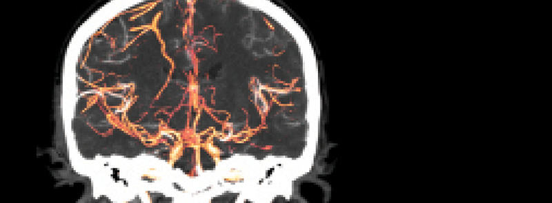 Asymptomatic Carotid Artery Stenosis