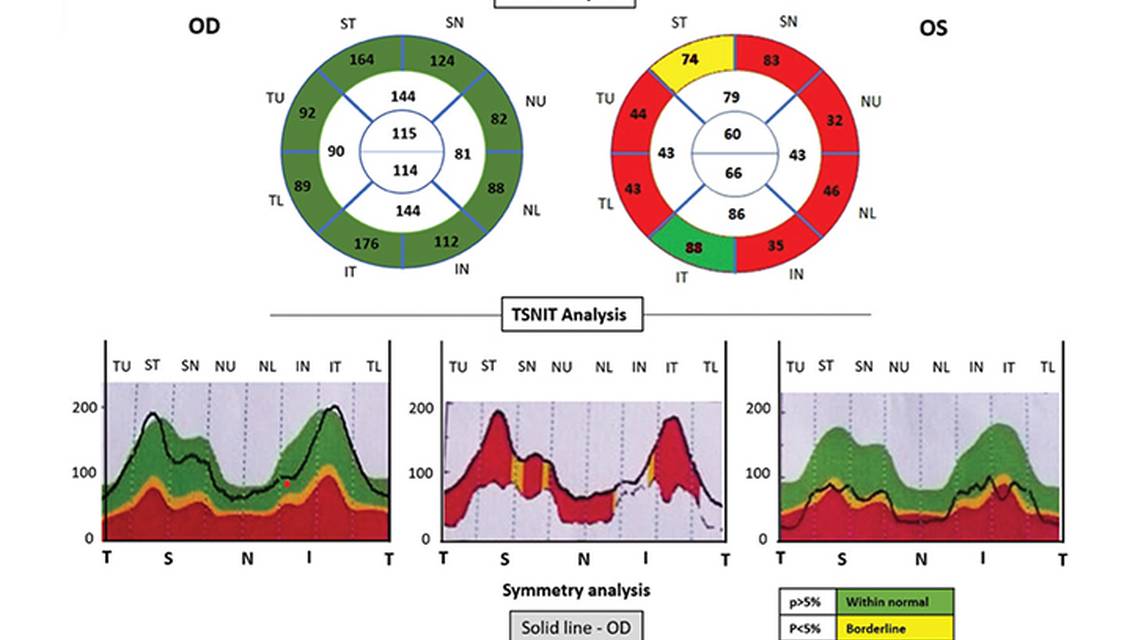 Neuromyelitis Optica Spectrum Disorder in Castleman Disease