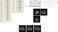 Epilepsy Essentials Application of Magnetoencephalography in the Diagnosis and Treatment of Epilepsy