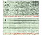 Spotlight on SleepDispelling the Sleep Spell Hypermotor Seizures Parasomnias and Leveraging Sleep Medicine in Pediatr