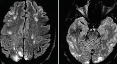 Vasculitis Presenting as a Hypertensive Crisis With Back Pain