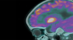 Two Cases of Nephrotic Syndrome Presenting as Ischemic Stroke