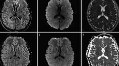 Reversible and Benign Lesions of Splenium of The Corpus Collosum