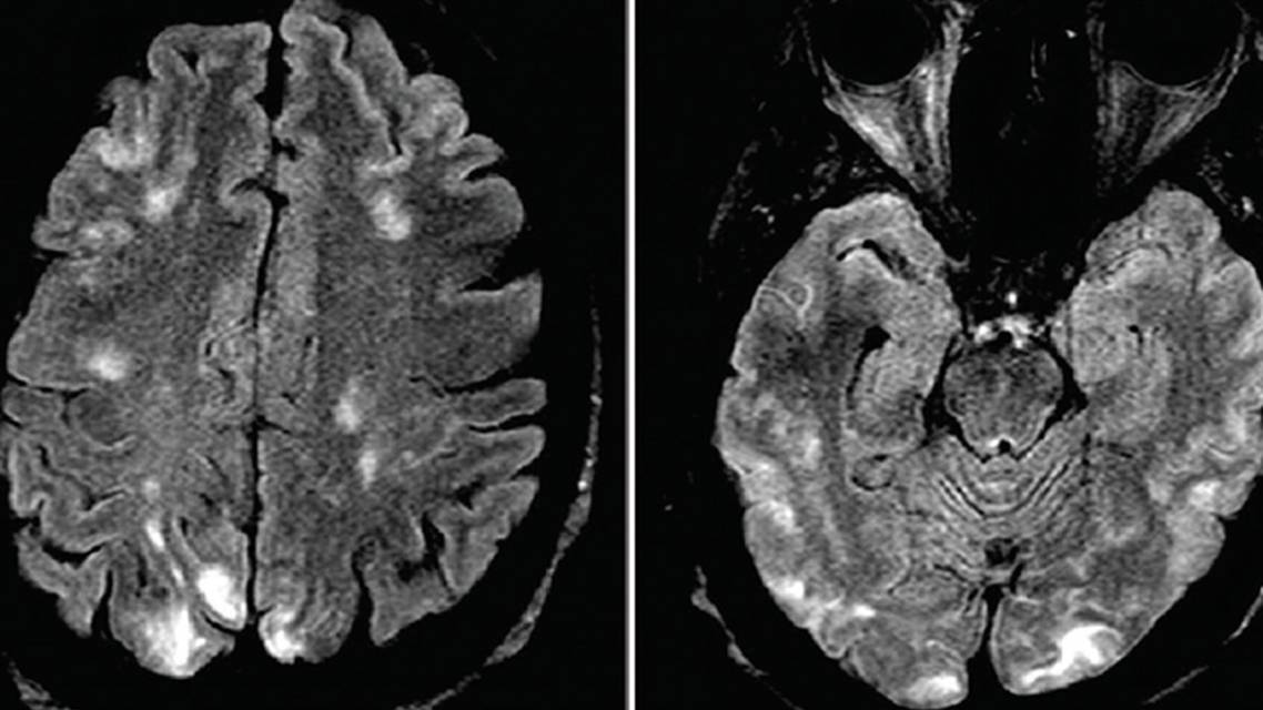 Vasculitis Presenting as a Hypertensive Crisis With Back Pain