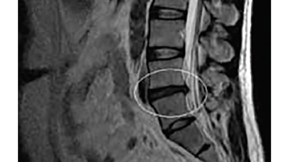 Spinal Pain Acute and Chronic Management