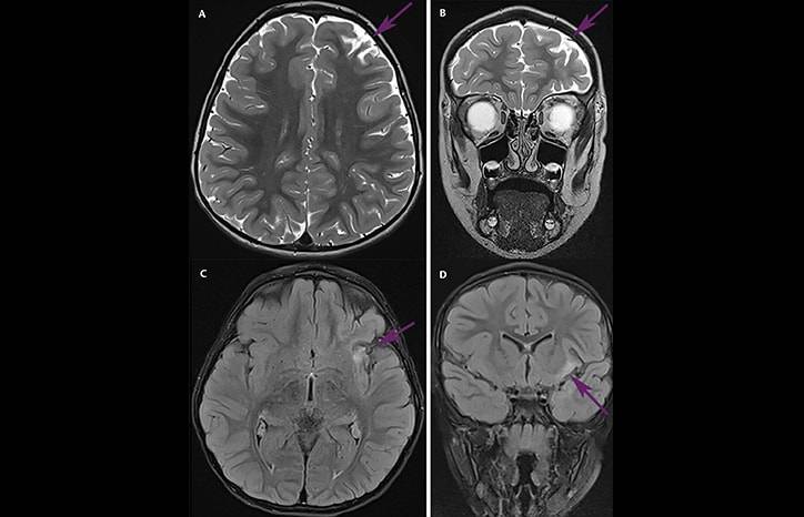 Progressive Drug Resistant Epilepsy and Behavior Changes