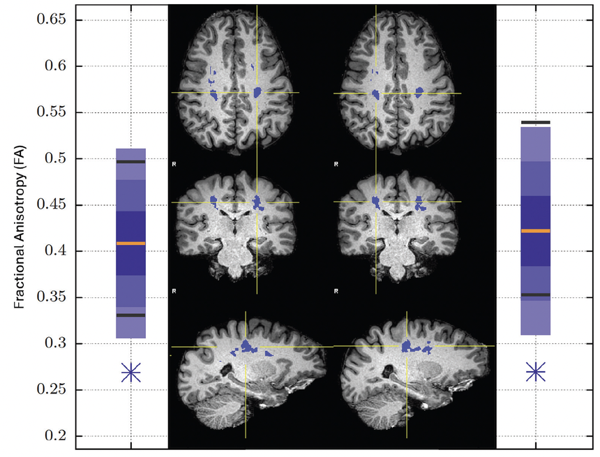 TBI Today: Quantitative Diffusion Tensor Imaging for Assessm