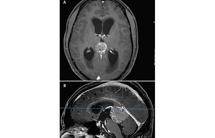 Hearing Loss Associated With Hydrocephalus