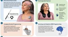 The New Era of Deep Brain Stimulation Programming in Parkinson Disease