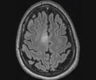 Challenge Case Report New Onset Seizures