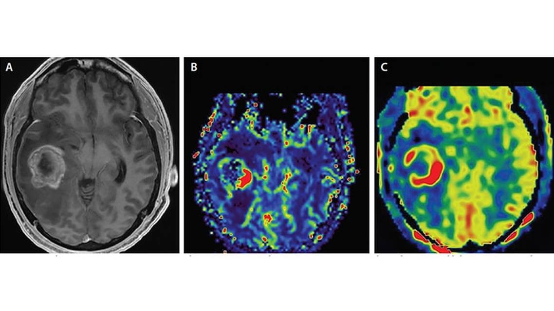 Brain Tumor Imaging