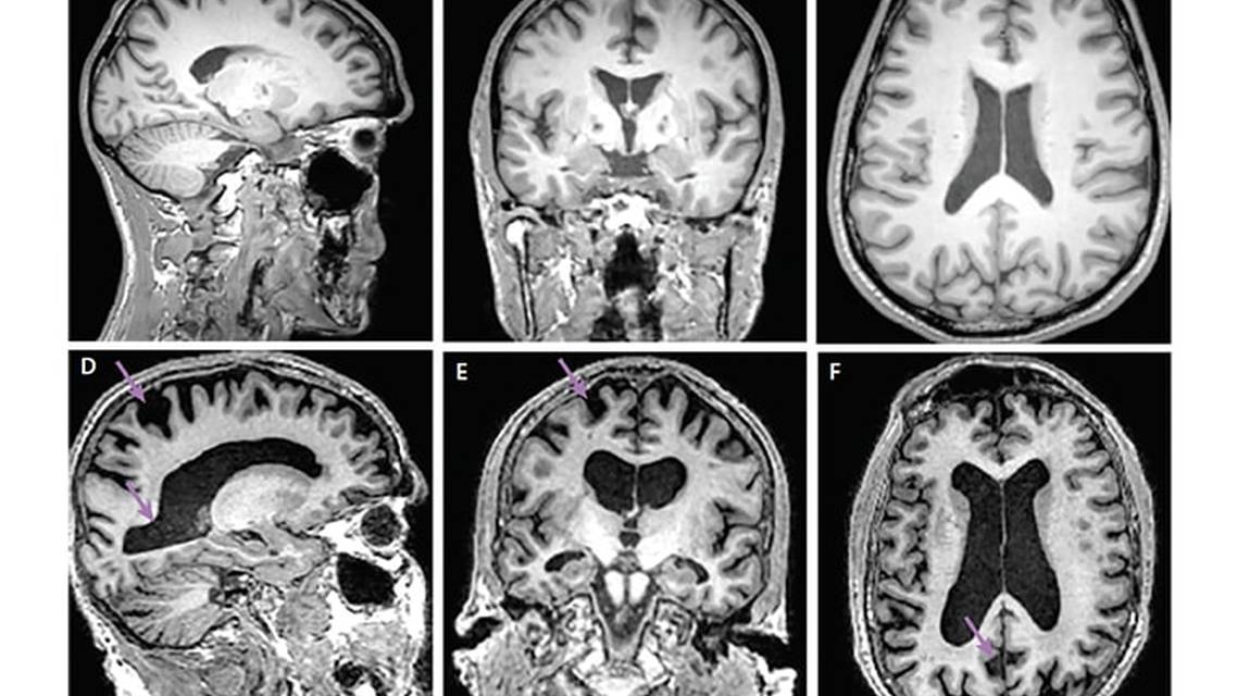 Neuroimaging and Alzheimers Disease