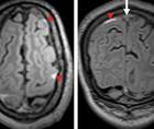Cerebral Venous Thrombosis Presenting as Recurrent Transient Ischemic AttackLike Episodes